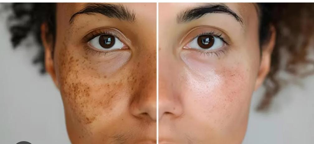 Laser Pigmentation Removal