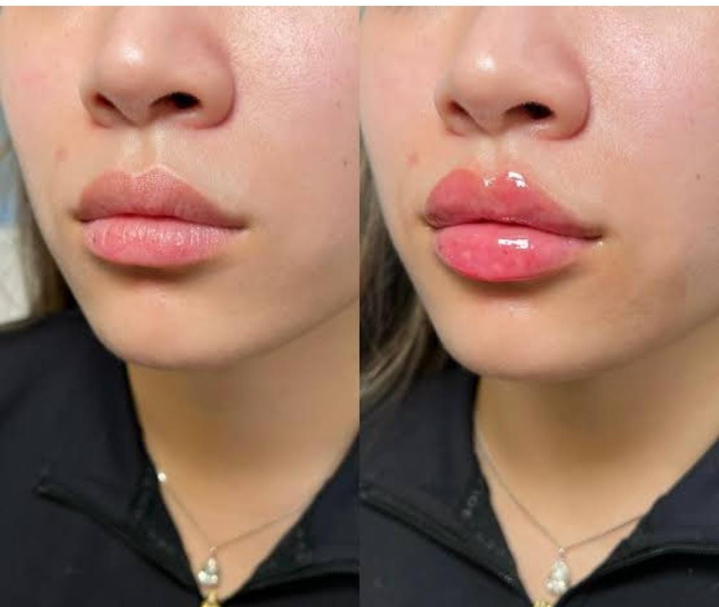 Lip Fillers